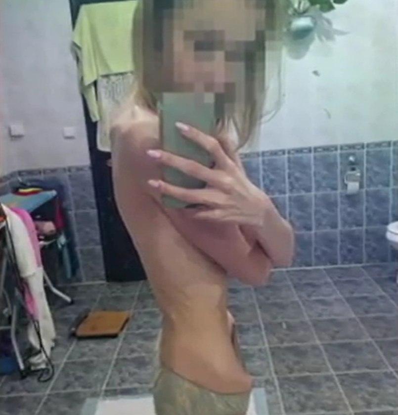 Анорексія вбила молоду українку: дівчина шокувала лікарів зовнішнім виглядом